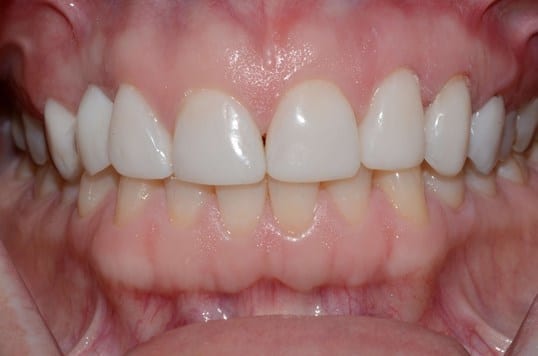 after veneers photo