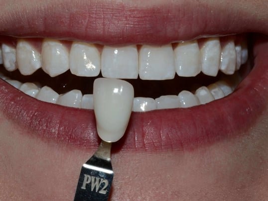 after whitening photo