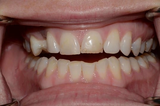 before veneers photo