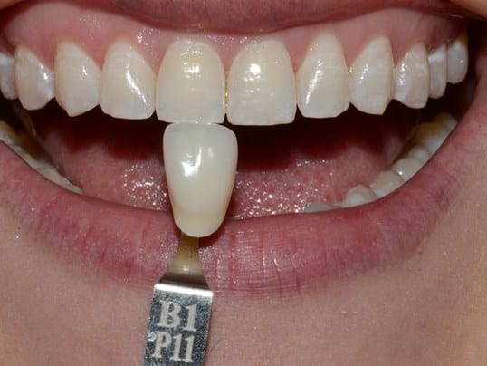 before whitening photo