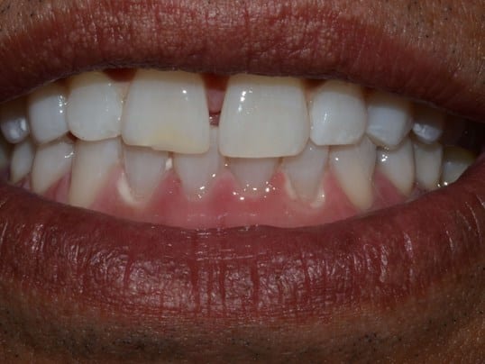 whitening after photo