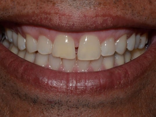 whitening before photo