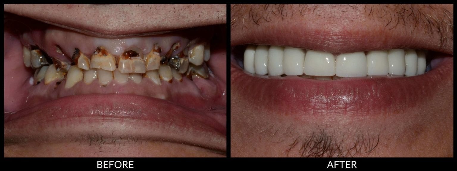 All On 4 Dental Implants in TriCities WA Kennewick, Richland, Pasco