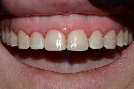 fillings after photo