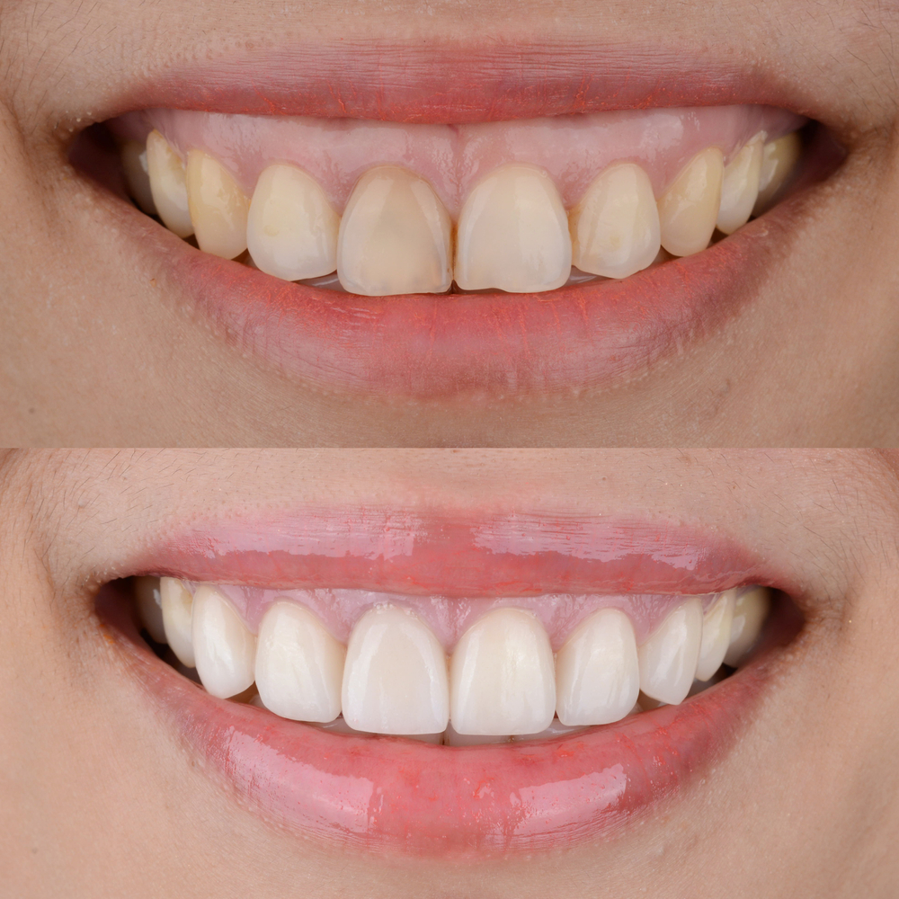 crown lengthening for gummy smile