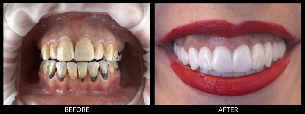 Copy of Veneers 2000x750 (1)