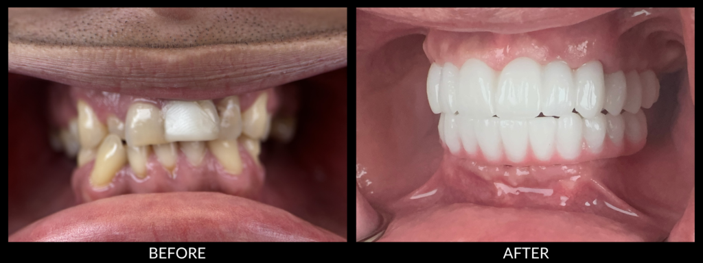 FP1 dental implants before and after Tri-Cities WA FP1 dental implants natural full arch result FP1 dental implants smile transformation Washington