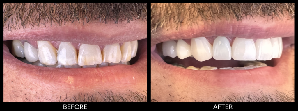 Porcelain Dental Veneers