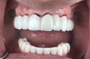 FP1 dental implants before and after Tri-Cities WA

FP1 dental implants natural full arch result

FP1 dental implants smile transformation Washington